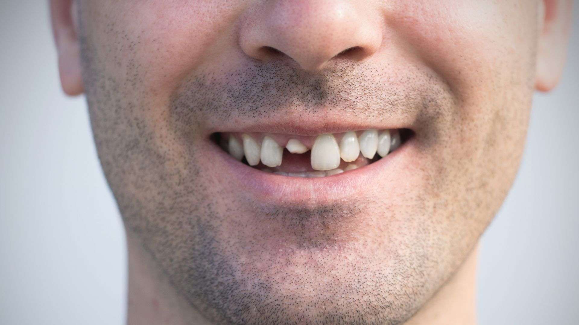 Restorative Rucker Restorative Options After Tooth Loss | Coniston Dental